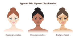 Types Of Pigmentation 