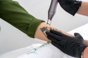 Tattoo Removal Treatment 