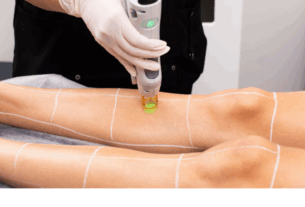 Laser Hair Removal