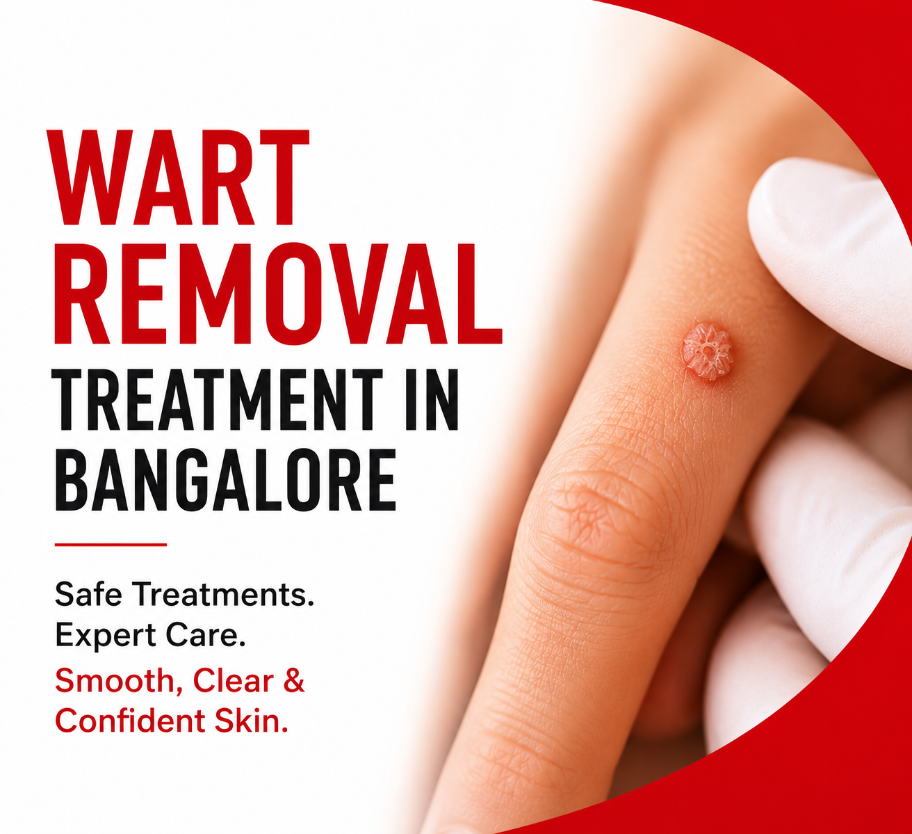 Wart removal treatment in Bangalore