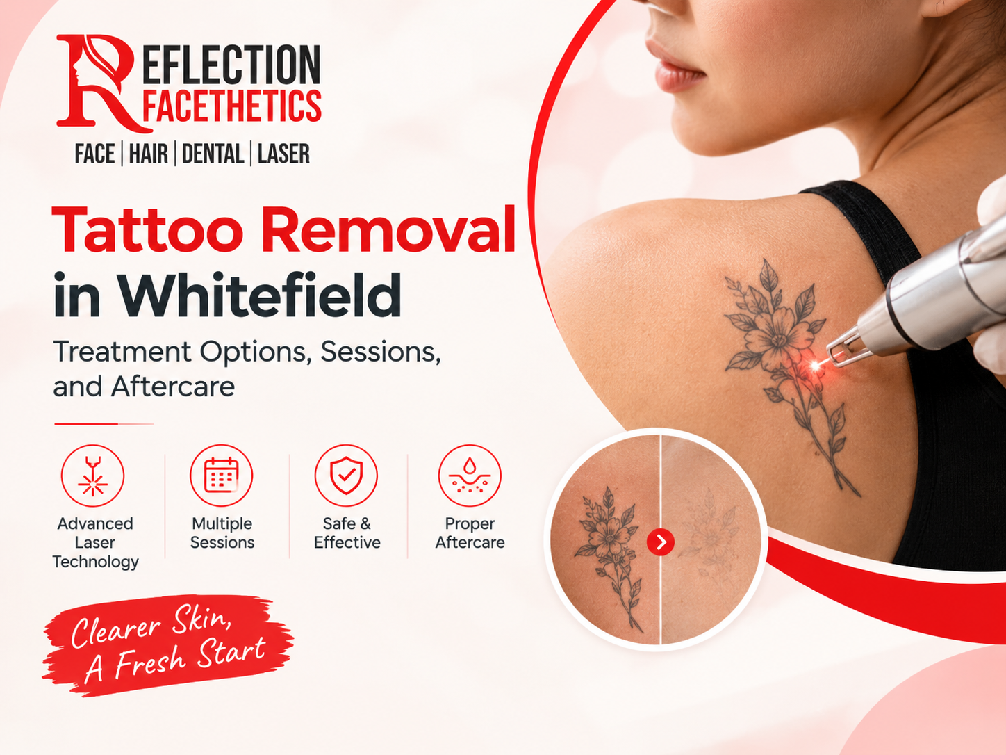 Tattoo Removal in Whitefield
