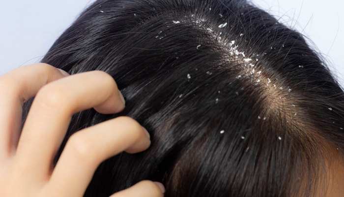 Dandruff Treatment in Bangalore