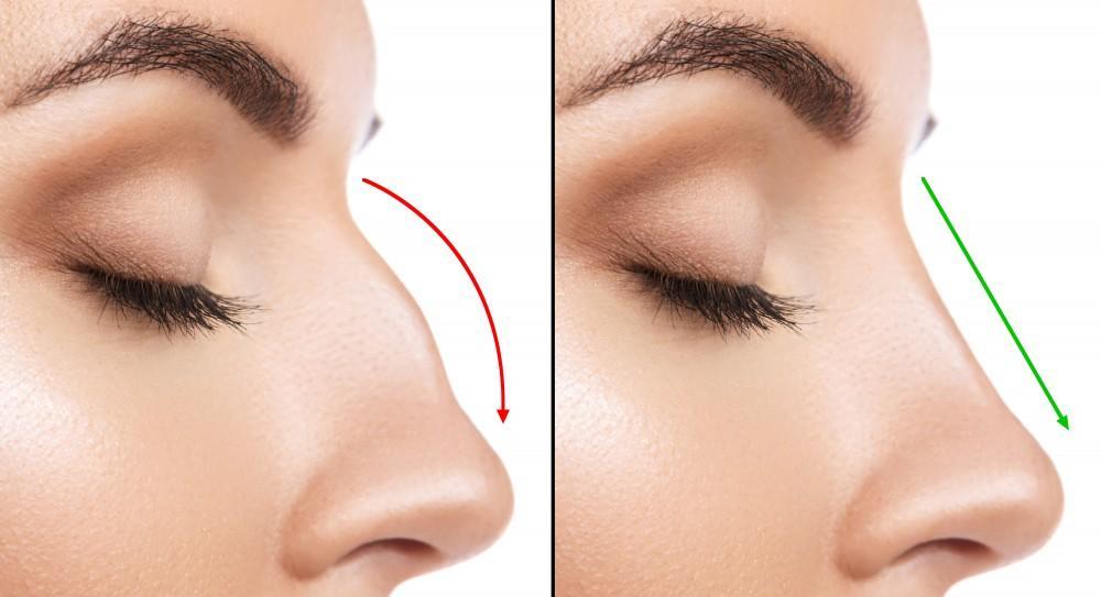 Rhinoplasty surgery in Bangalore