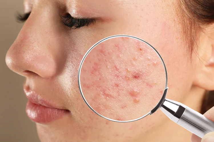 Acne Treatment in Bangalore