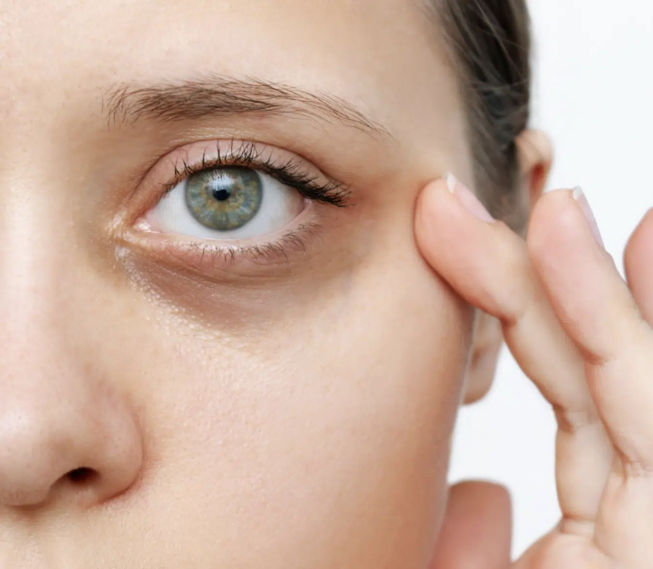 Dark Circles Removal Treatment in Bangalore