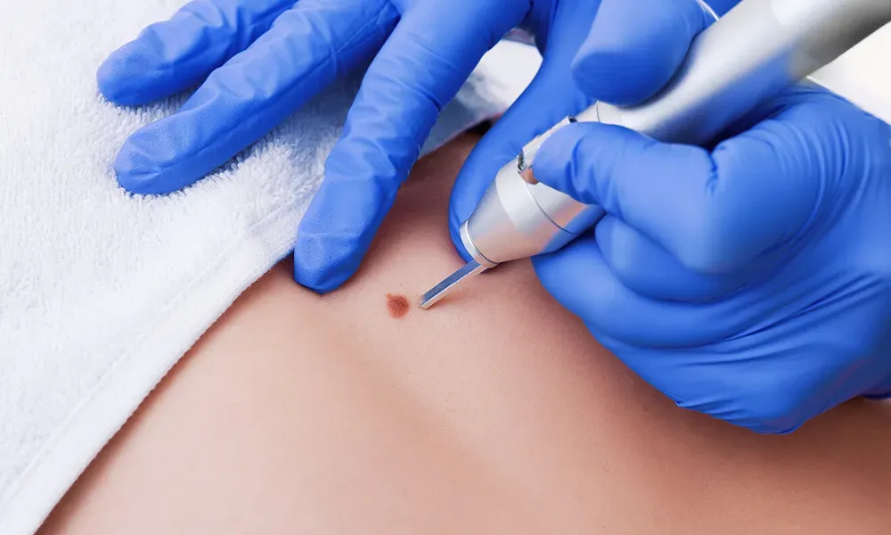 Skin Tag Removal In Bangalore