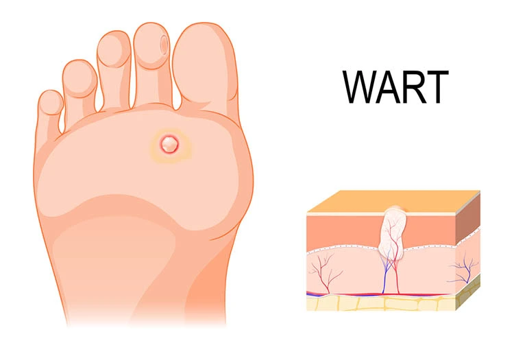 Wart Removal Treatment  in Bangalore